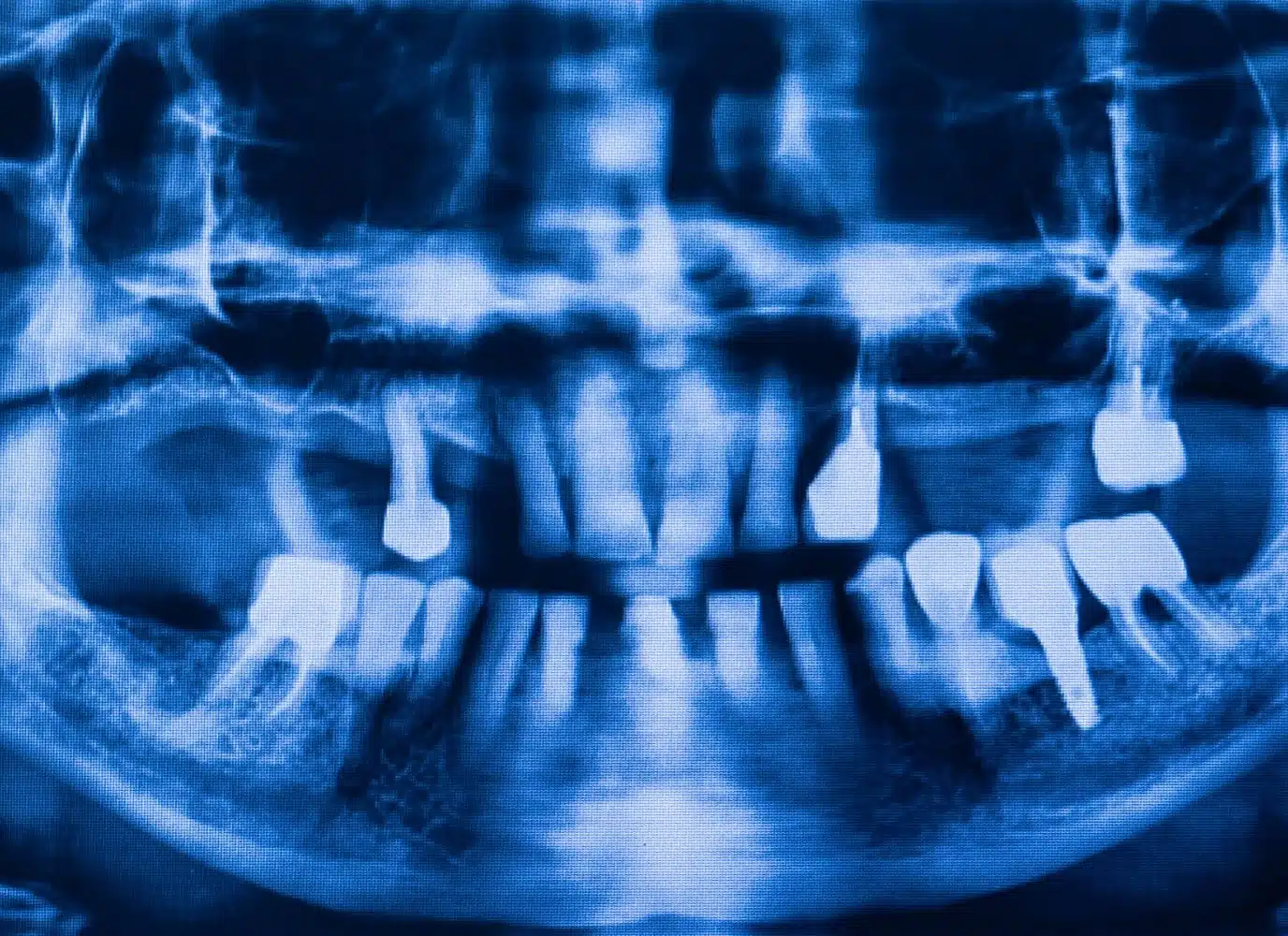 Image rayon X des dents Dentascanner Scanner dentaire | Groupe Revelis