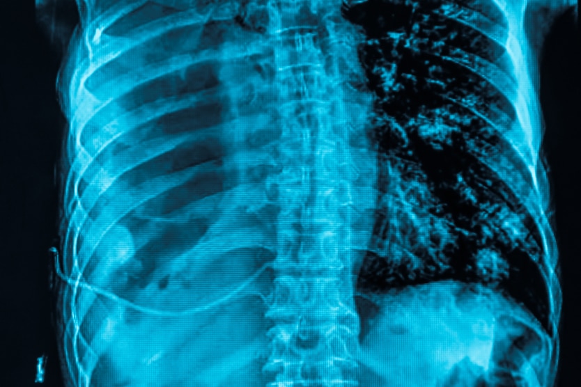 Infiltration | Radiologie | Révélis | Paris