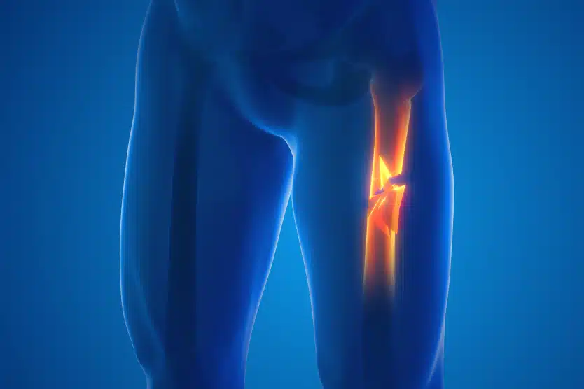 IRM cuisse dans quels cas prescrit examen musculaire | Radiologie | Révélis | Paris