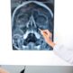 Scanner des sinus : quand le prescrire en cas de sinusite chronique ?